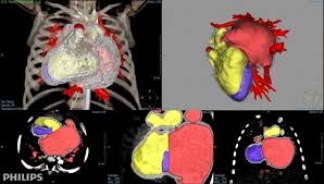 Philips IntelliSpace Portal for CT Cardiac