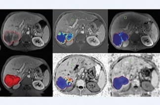 Philips IntelliSpace IX/LX Workstation for CT Oncology